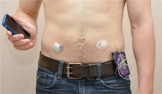 {'en': 'Artificial pancreas improves the treatment of type 1 diabetes', 'es': 'Páncreas artificial mejora el tratamiento de la diabetes tipo 1'} Image