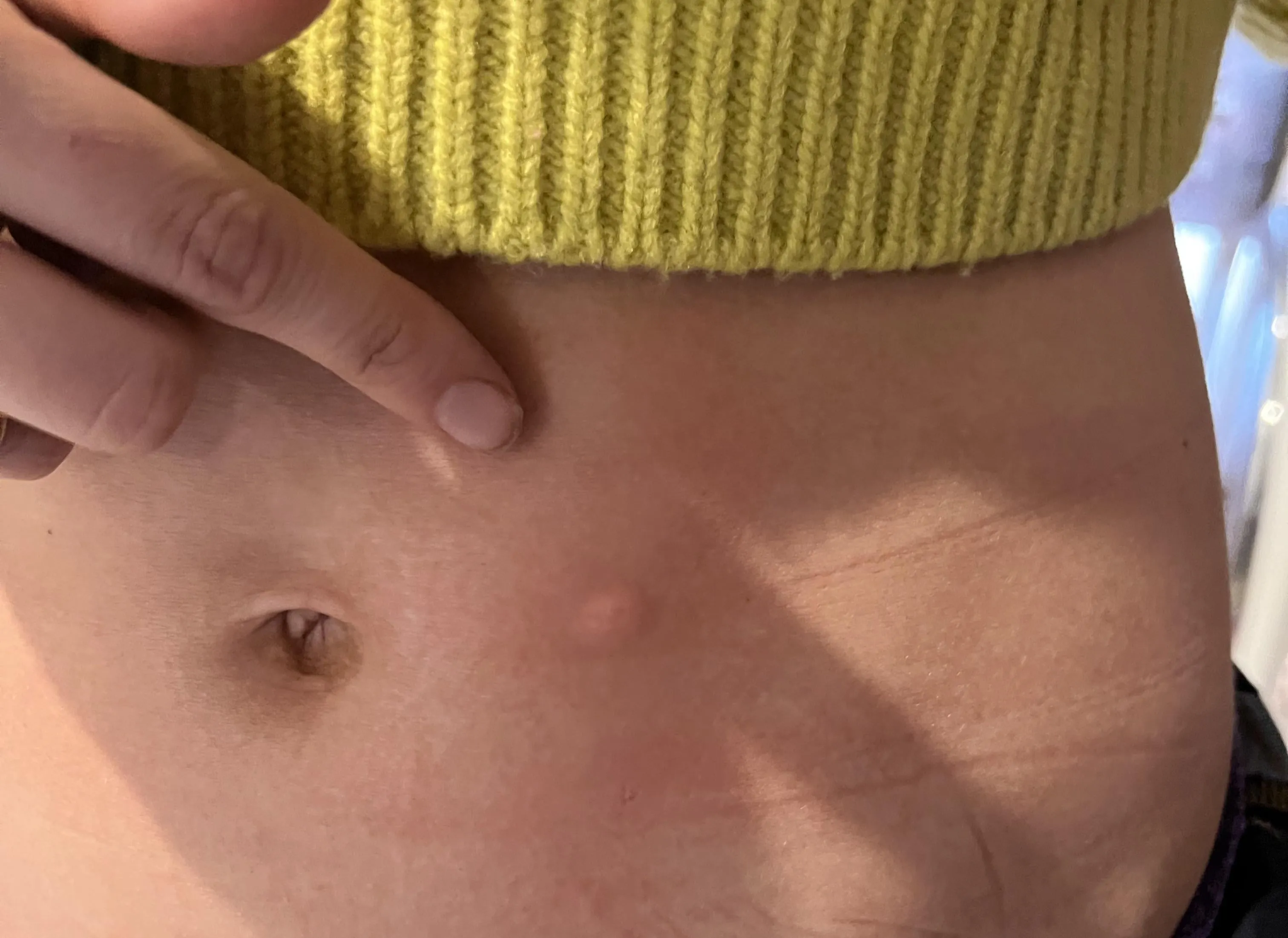 {'en': 'I have lumps of the punctures', 'es': 'Tengo bultos de los pinchazos'} Image