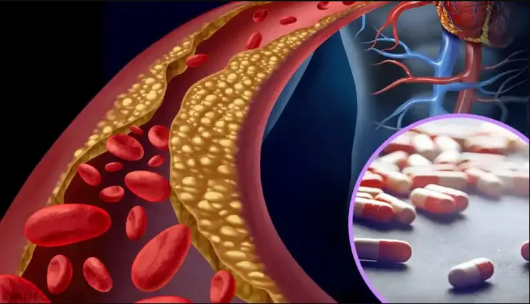 {'en': 'Diabetes-Colesterol-Statines', 'es': 'Diabetes-colesterol-estatinas'} Image