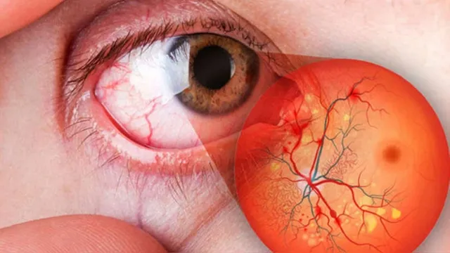 {'en': 'Diabetic retinopathy affects 4 out of 10 Mexicans with diabetes', 'es': 'Retinopatía diabética afecta a 4 de cada 10 mexicanos con diabetes'} Image