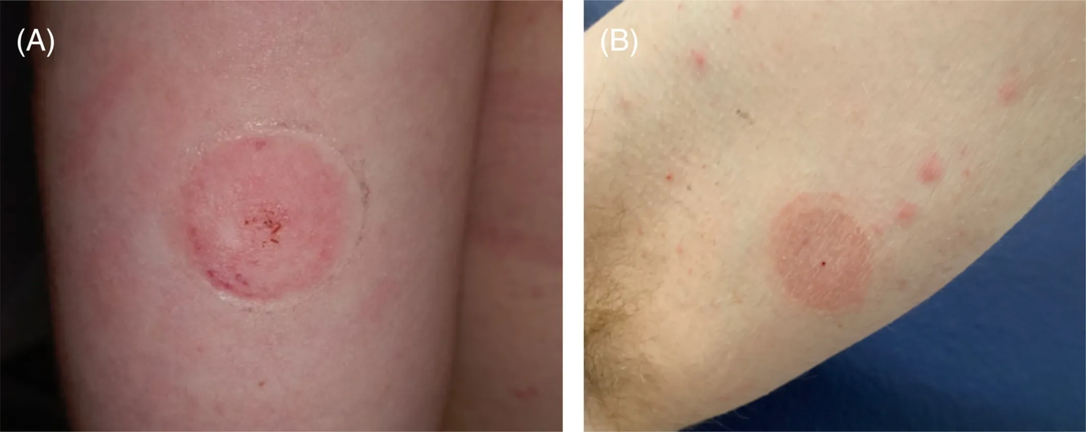 {'en': 'Allergic reaction with the freestyle patch', 'es': 'Reacción alergica con el parche freestyle'} Image