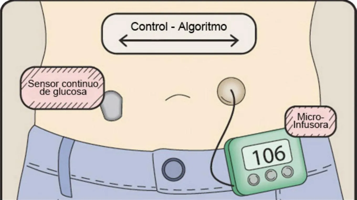 {'en': 'The first artificial pancreas is a reality in Argentina', 'es': 'El primer páncreas artificial es una realidad en la Argentina'} Image