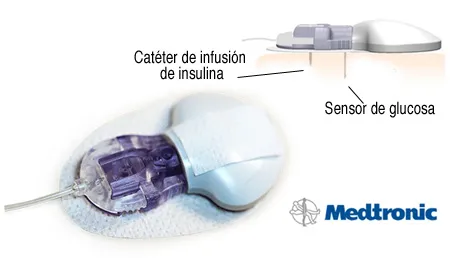 {'en': 'Insulina Medtronic Cateter Pumps Oblique', 'es': 'Bombas de Insulina Medtronic Cateter oblicuos'} Image