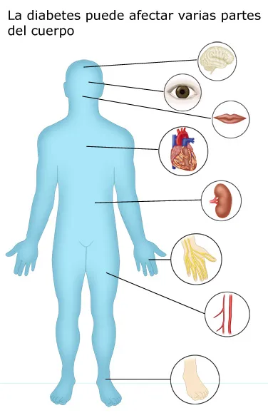 {'en': 'Diabetes and complication', 'es': 'Diabetes y complicadiones'} Image