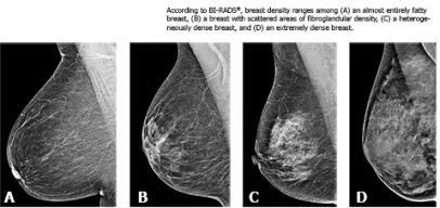 {'en': 'Diabetes treatment can reduce breast density', 'es': 'El tratamiento de la diabetes puede reducir la densidad mamaria'} Image