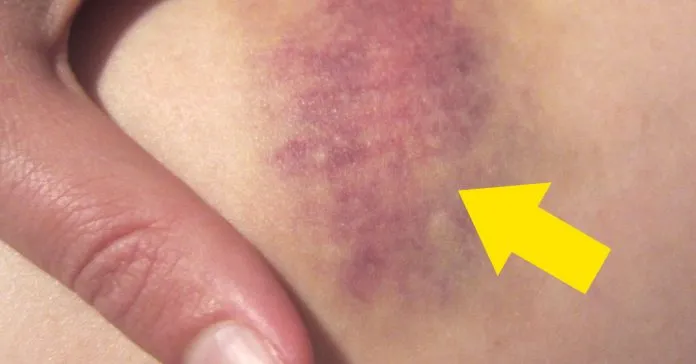 {'en': 'Hematomas or purple when putting insulin?', 'es': '¿Hematomas o morados al poner la Insulina?'} Image