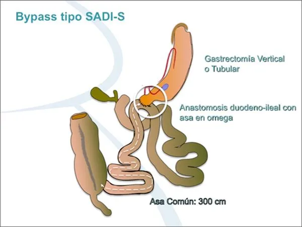 {'en': 'Obesites clinic performs gastric bypass that "cures" some cases of type 2 diabetes', 'es': 'Clínica Obesitas realiza bypass gástrico que "cura" algunos casos de diabetes tipo 2'} Image